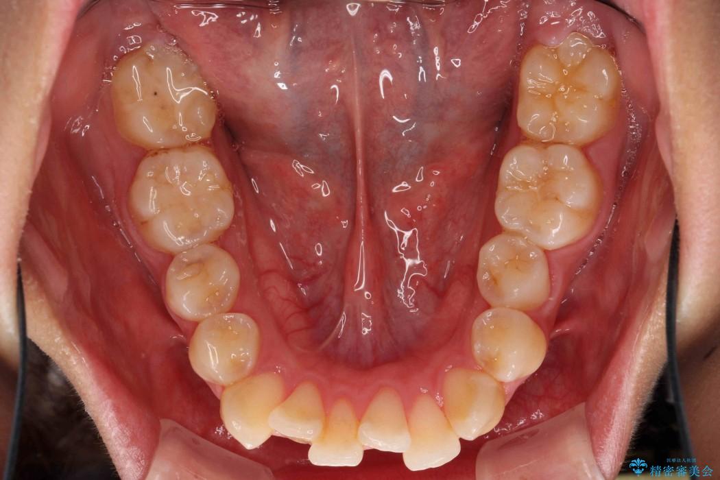 他院で治療した出っ歯の再矯正 治療前画像