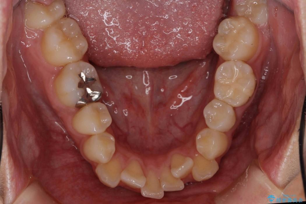 反対咬合（奥歯）のワイヤー矯正治療 治療前画像