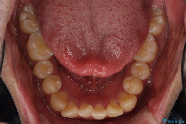 前歯のガタガタと奥歯の噛み合わせの矯正 治療前画像