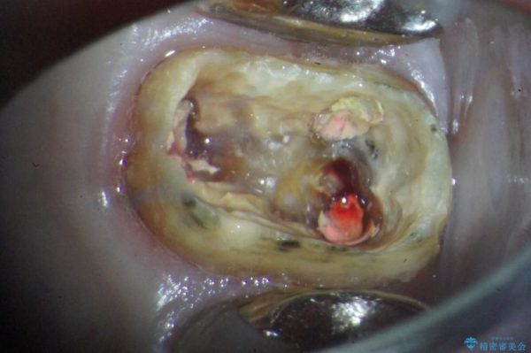 大きな穴があいた奥歯のブリッジ治療 治療前画像