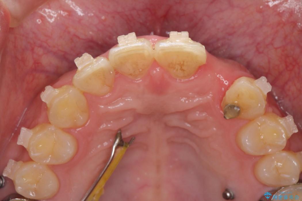 上の前歯のインプラント治療 治療前画像
