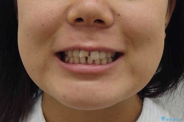 20代女性 すきっ歯の矯正歯科治療 治療前画像