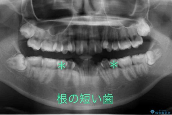 根の短い歯を抜歯 がたがたの歯並び矯正 治療前画像