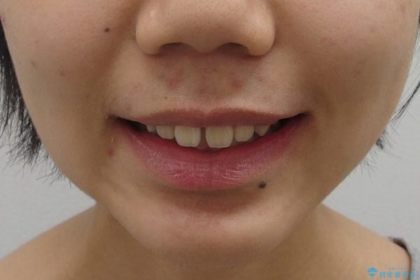 前歯のすき間と過蓋咬合のワイヤー矯正 治療前画像