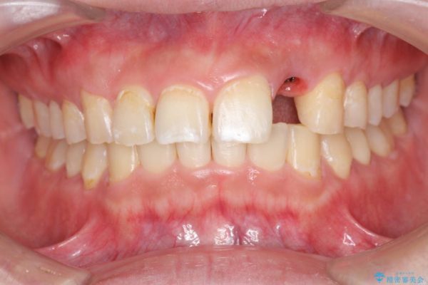 左上前歯のインプラント治療（セラミック治療編） 治療前画像