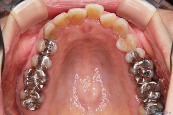 テトラサイクリンによる変色歯のセラミック治療 治療前画像