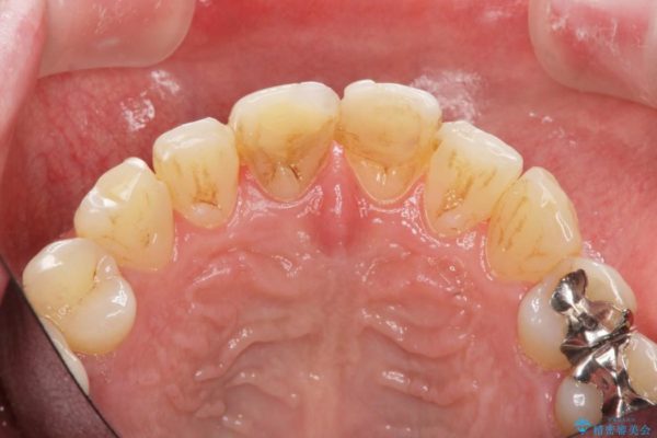 神経が無い歯のセラミック治療 治療前画像