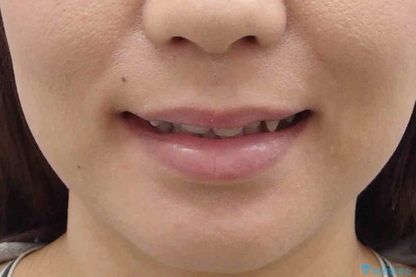天然歯を活かす、スレ違い咬合矯正 治療前画像