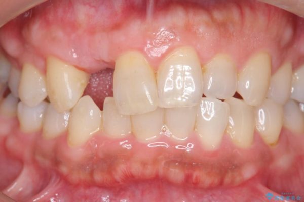 前歯のインプラント治療(セラミック治療編) 治療前画像