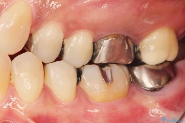 ＜メタルフリー＞銀歯のセラミック治療 治療前画像