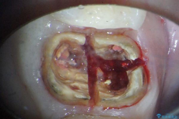 大きな穴があいた奥歯のブリッジ治療 治療前画像
