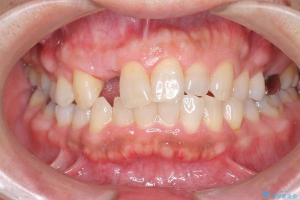 前歯のインプラント治療(セラミック治療編) 治療前画像