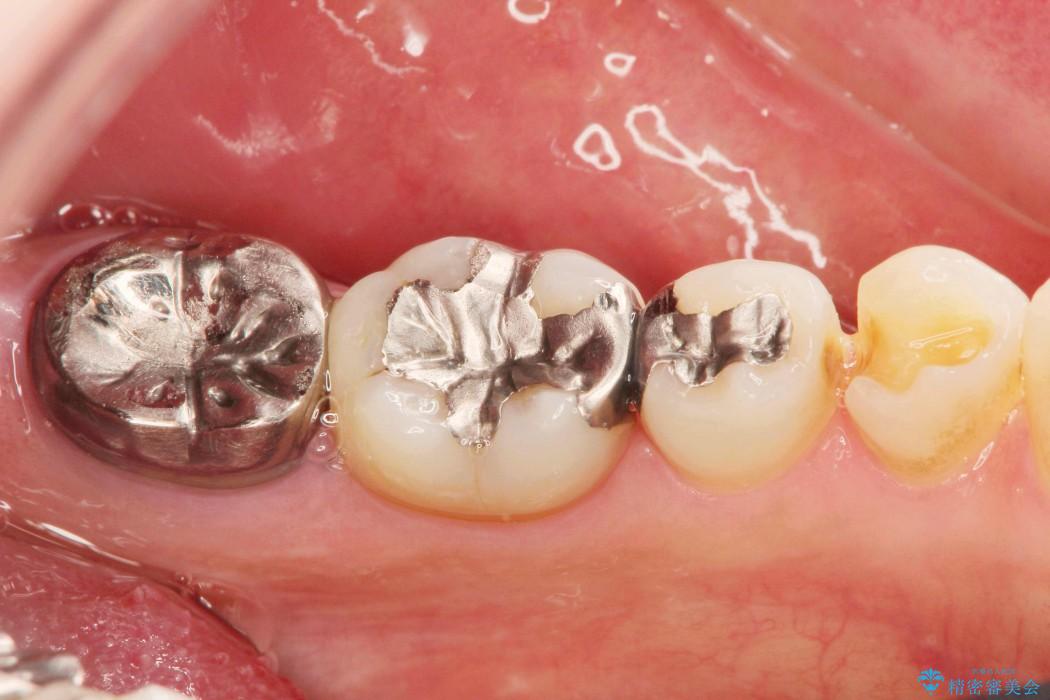 ＜メタルフリー＞銀歯のセラミック治療 治療前画像