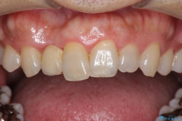 前歯のインプラント治療(インプラント埋入まで) 治療前画像