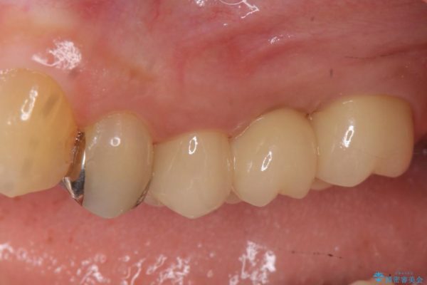 大きな穴があいた奥歯のブリッジ治療 アフター