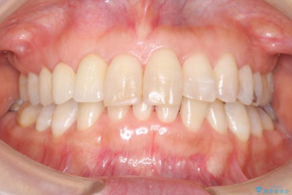 気になる前歯を矯正とセラミックの低予算治療 治療後画像