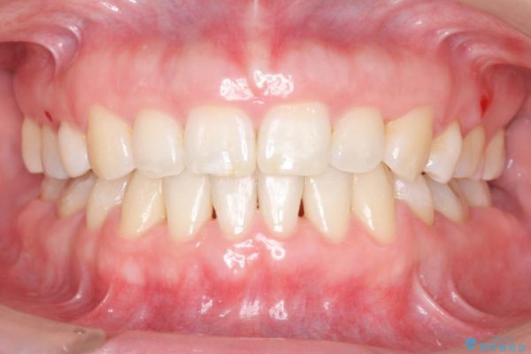 30代女性 出っ歯の再矯正治療 アフター