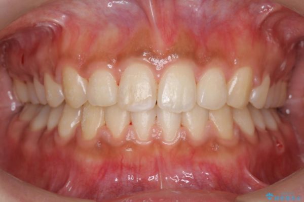 20代女性 すきっ歯の矯正歯科治療 アフター
