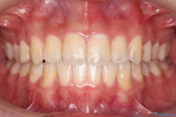 前歯の叢生のインビザライン矯正 アフター