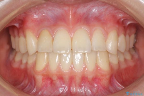 インビザラインで再矯正治療と右上前歯のセラミック治療 治療後画像