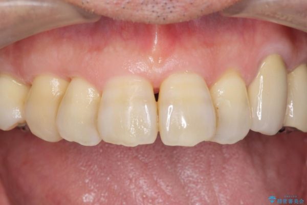 エムドゲインを用いた中等度歯周病治療 治療後画像