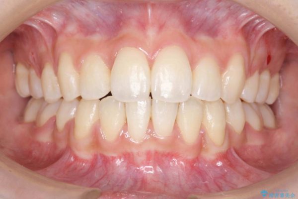 根の短い歯を抜歯 がたがたの歯並び矯正 アフター