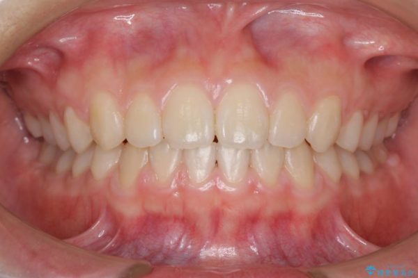 前歯のすき間と過蓋咬合のワイヤー矯正 治療後画像