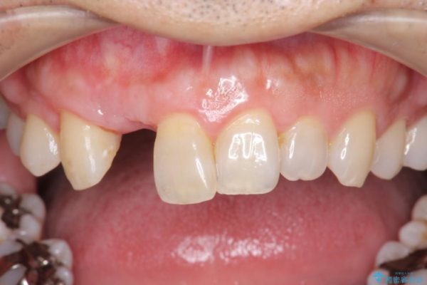 前歯のインプラント治療(インプラント埋入まで) アフター