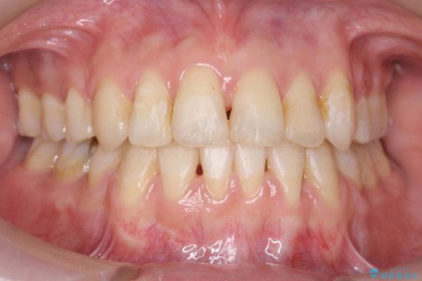 反対咬合（奥歯）のワイヤー矯正治療 治療後画像