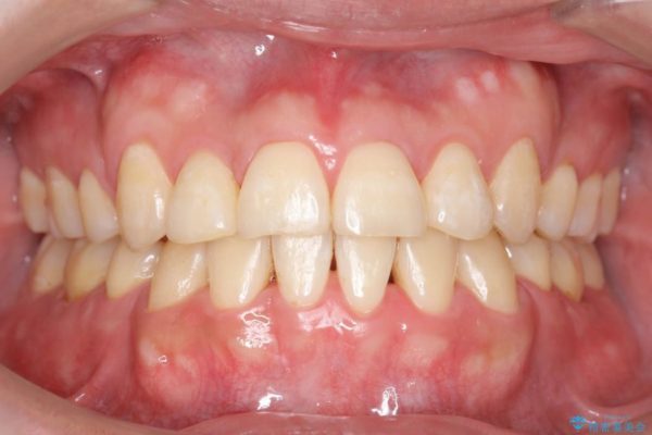 前歯のガタガタと奥歯の噛み合わせの矯正 アフター