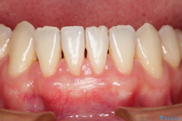 【歯肉退縮】歯ぐきの再生治療（歯茎の移植） 治療後画像