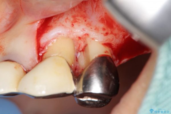 重度歯周病治療(歯槽骨の再生治療) 治療後画像