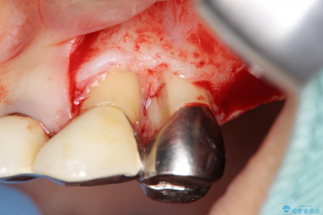 重度歯周病治療(歯槽骨の再生治療) アフター