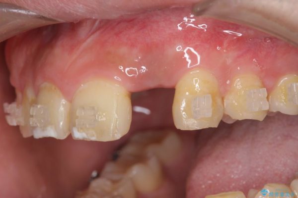 左上前歯のインプラント治療（インプラント埋入まで） アフター