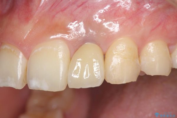 左上前歯のインプラント治療（セラミック治療編） アフター