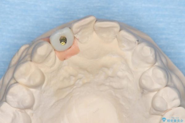 前歯のインプラント治療(インプラント埋入まで) 治療後画像
