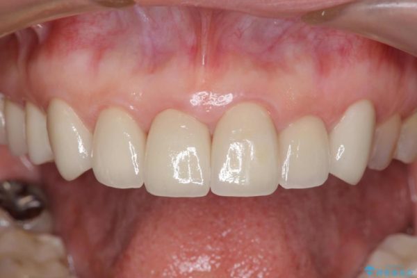 テトラサイクリンによる変色歯のセラミック治療 アフター