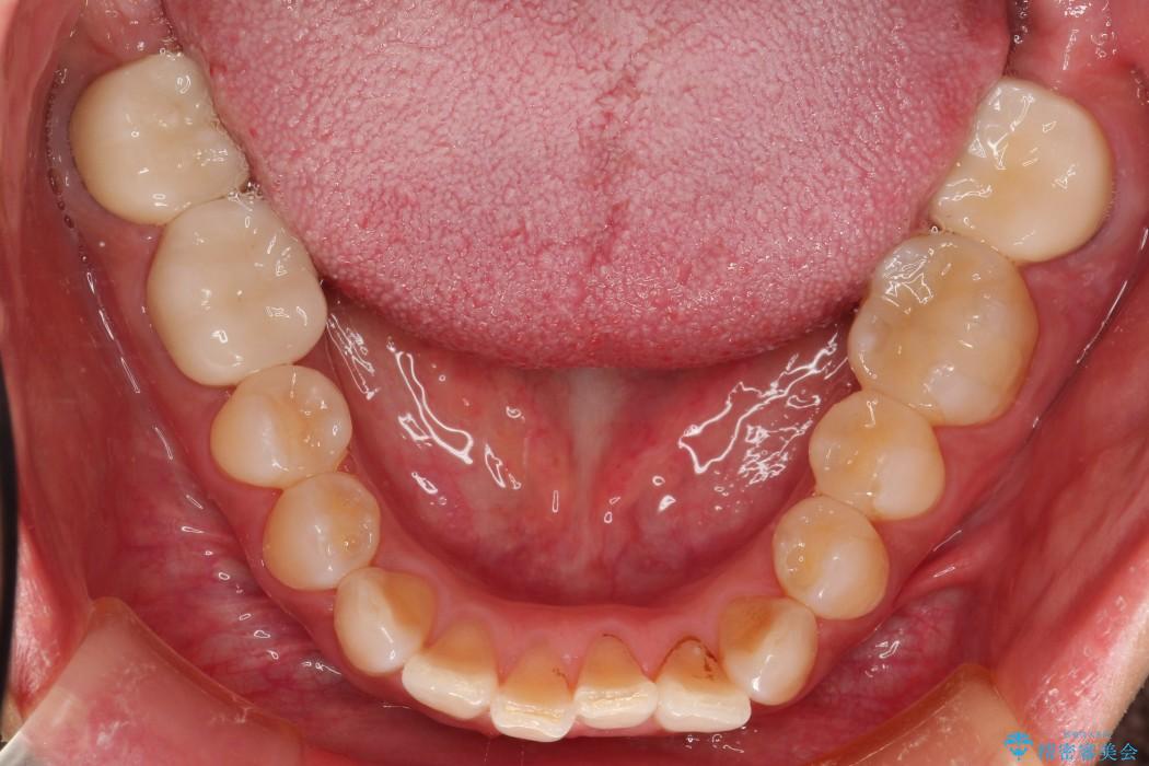 ＜メタルフリー＞銀歯のセラミック治療 治療後画像