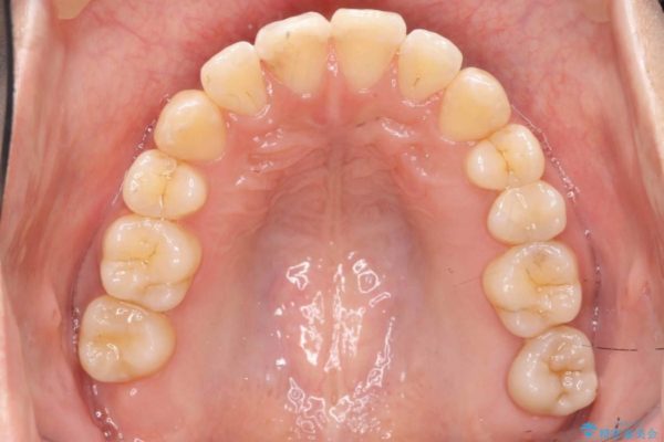 天然歯を活かす、スレ違い咬合矯正 治療後画像