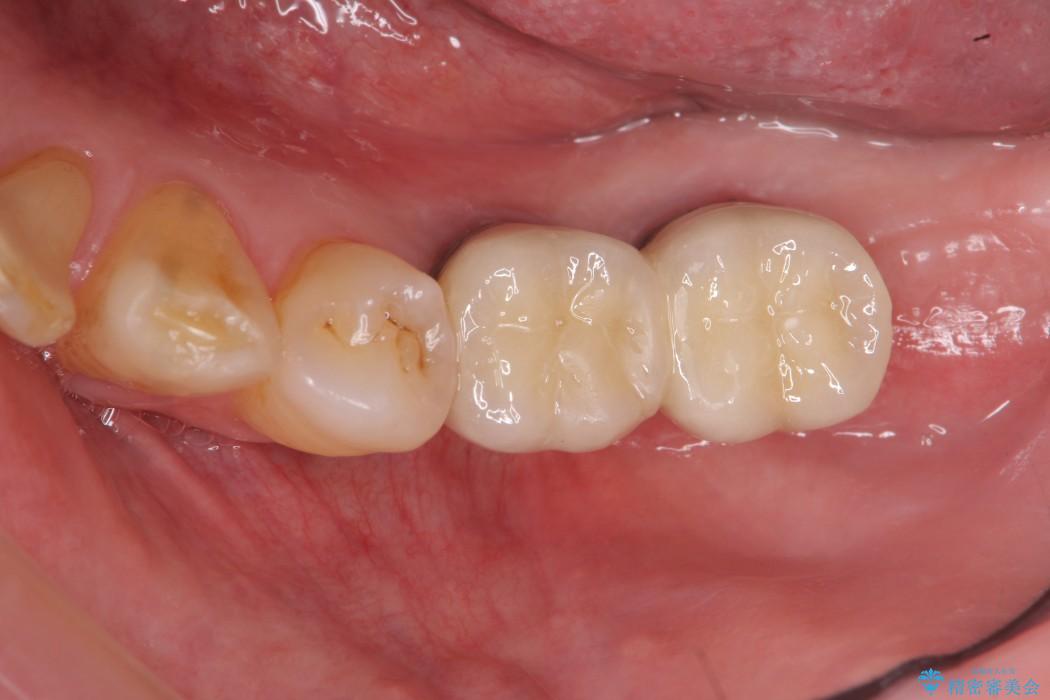 奥歯で噛みたいインプラント治療 治療後画像