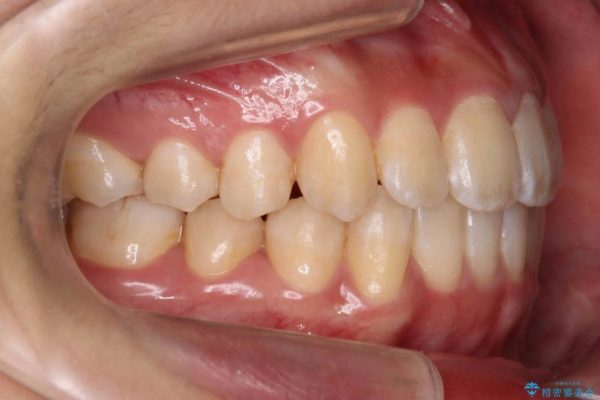 前歯の叢生のインビザライン矯正 治療後画像