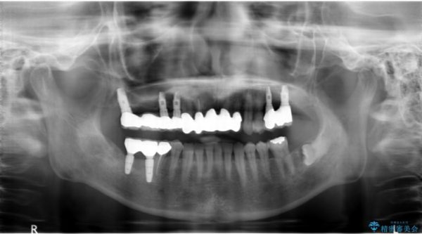 インプラントを用いた重度歯周病治療 治療後画像