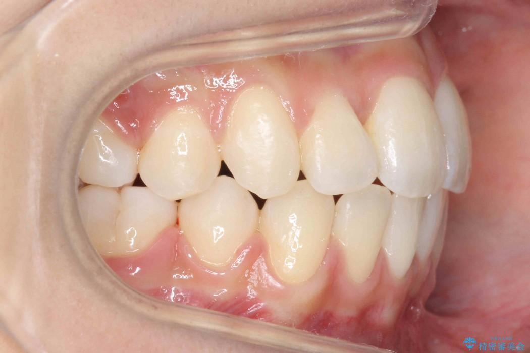 根の短い歯を抜歯 がたがたの歯並び矯正 治療後画像