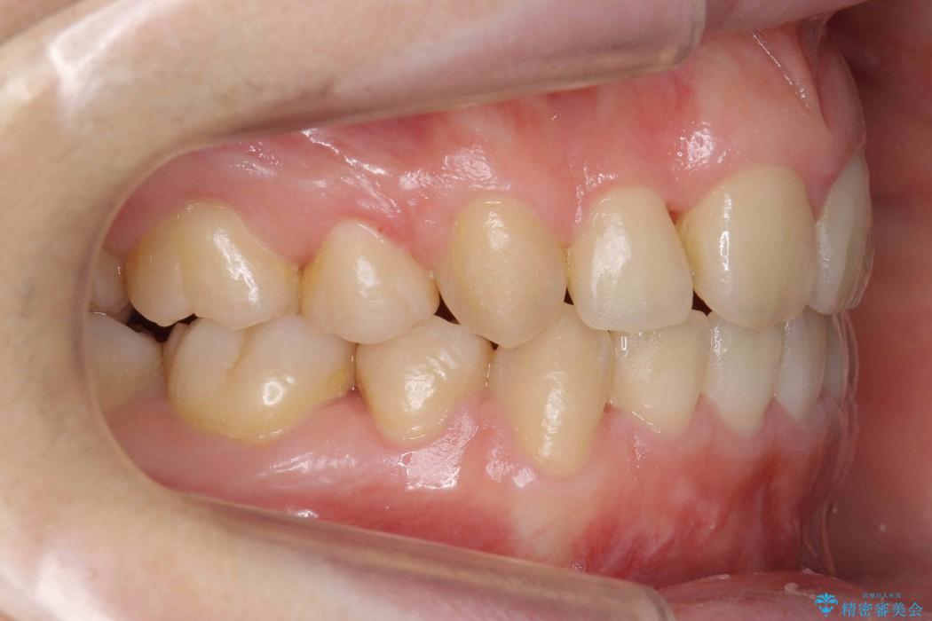 前歯のねじれと出っ歯の矯正 治療後画像