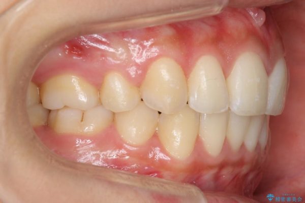 他院で治療した出っ歯の再矯正 治療後画像
