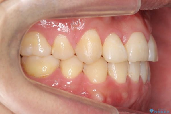 前歯のガタガタと奥歯の噛み合わせの矯正 治療後画像
