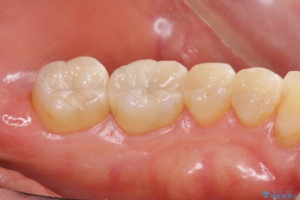 銀歯を白くするセラミックインレー 治療後画像