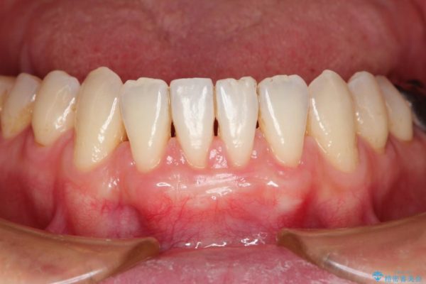 【歯肉退縮】歯ぐきの再生治療（歯茎の移植） 治療後画像