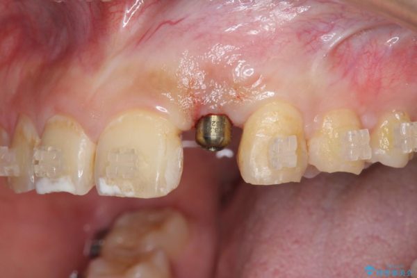 左上前歯のインプラント治療（インプラント埋入まで） 治療後画像