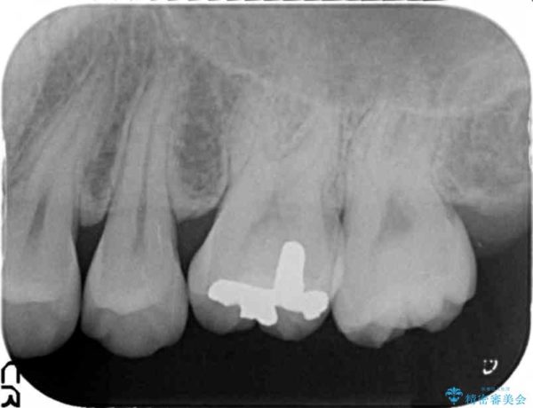 上の奥歯のゴールドインレー 治療後画像